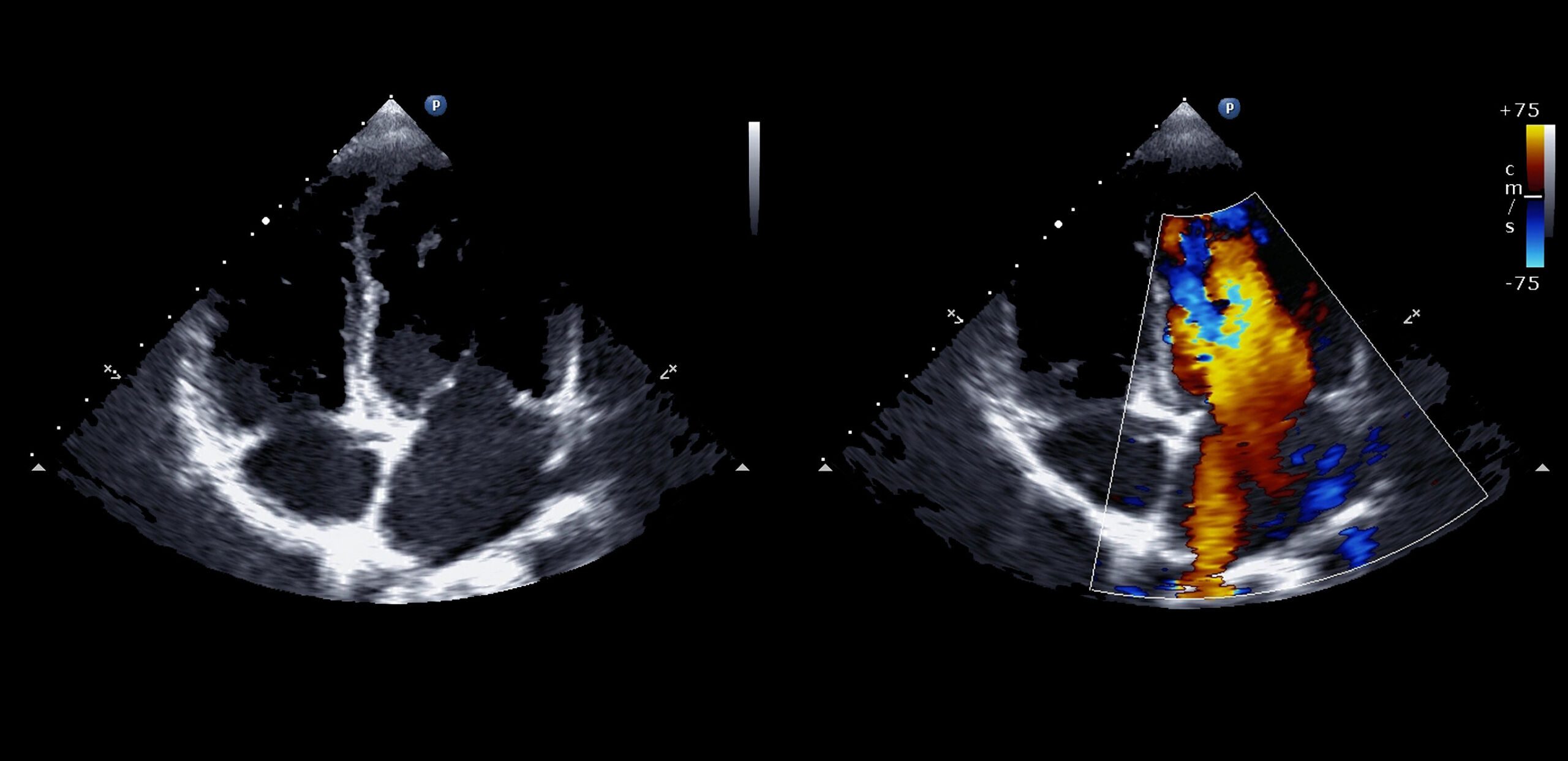 Image from echocardiography scan at Cooley Dickinson Hospital, 30 Locust Street, Northampton, MA 01060.