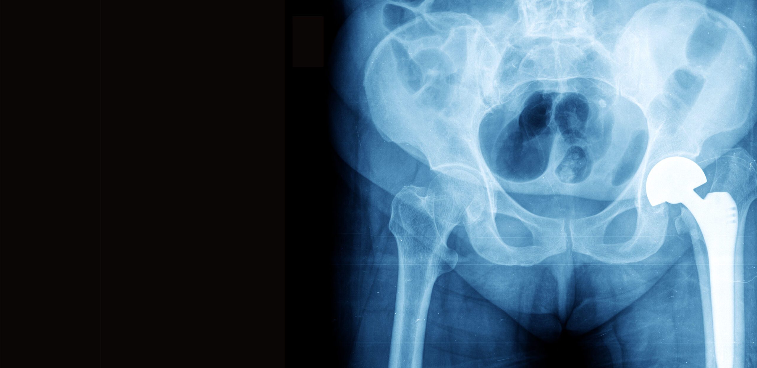 X-ray of hip joint, Joint Replacement Center at Cooley Dickinson Hospital, Northampton, MA 01060