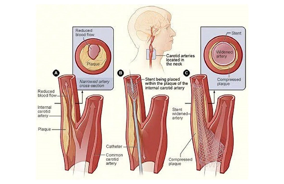 Carotid stent, Cooley Dickinson Hospital, 30 Locust Street, Northampton, MA 01060.