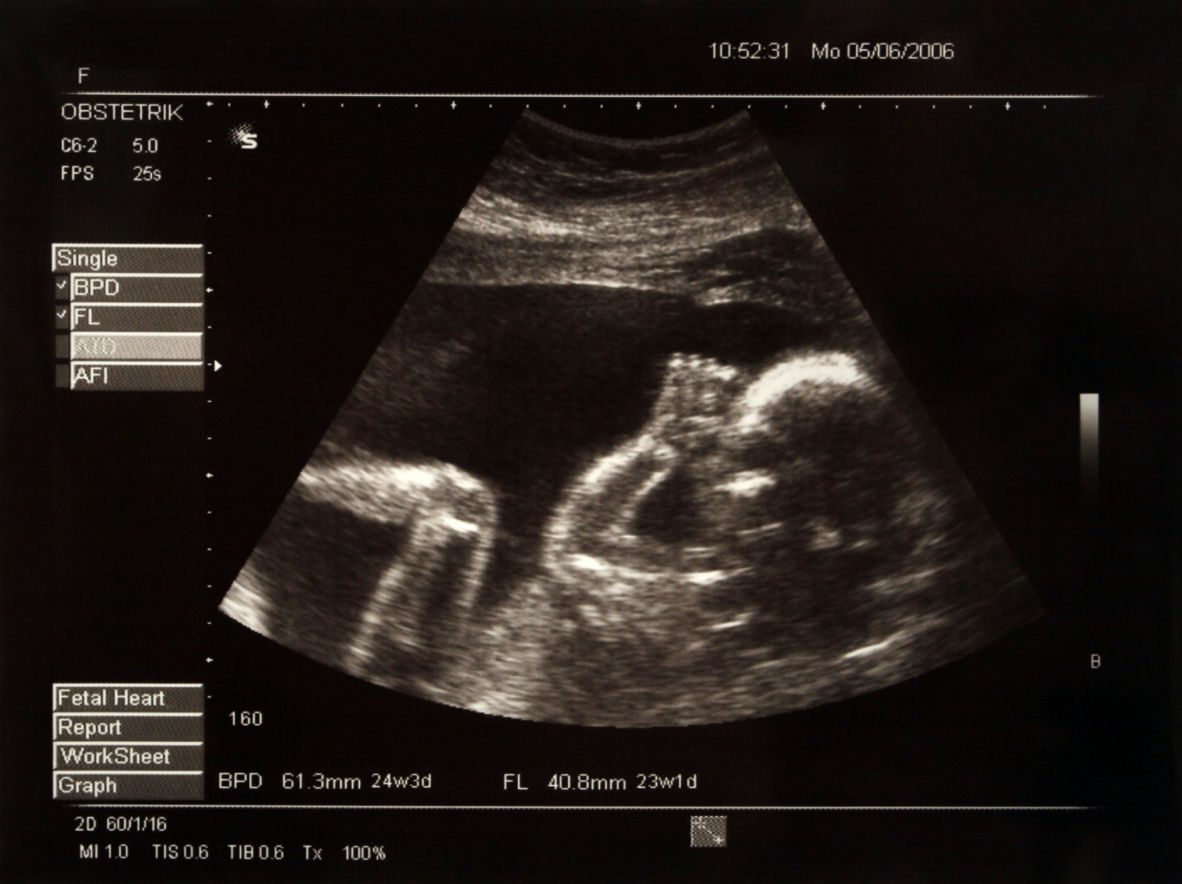 Ultrasound image of baby in womb, Cooley Dickinson Hospital, 30 Locust Street, Northampton, MA 01060.