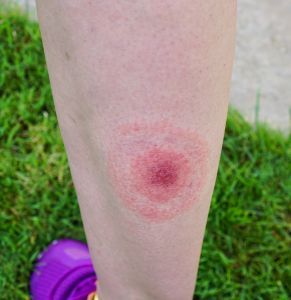 Person's leg with bullseye rash.
