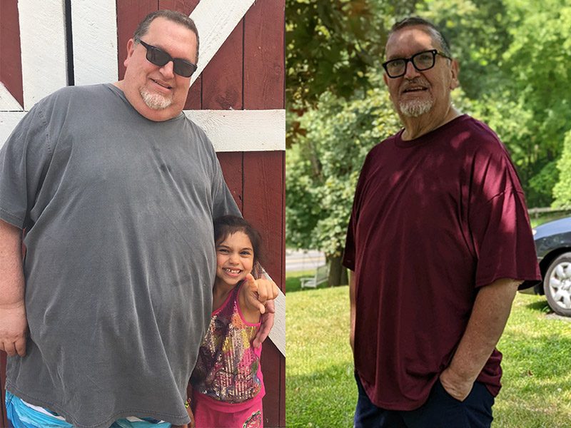 Weight loss surgery patient Charles Peterson before and after his sleeve gastrectomy bariatric surgery.
