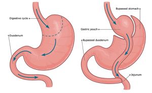 Diagram of gastric bypass surgery