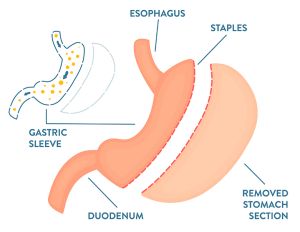 Diagram of gastric sleeve procedure