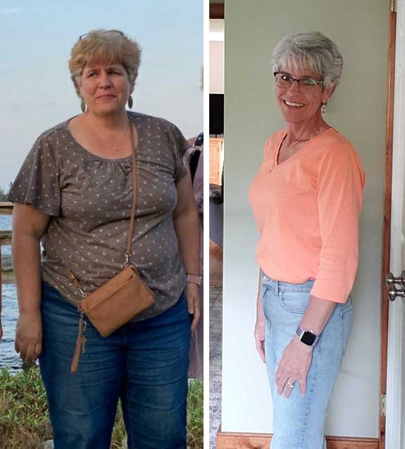 Mary Fournier shown before and after her Sleeve Gastrectomy